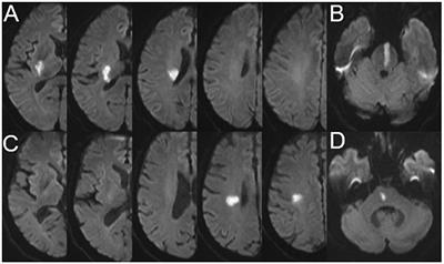 Clinical factors associated with functional outcomes in patients with single subcortical infarction with neurological deterioration